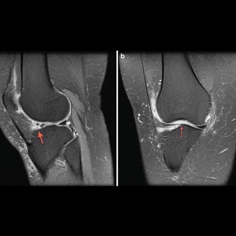 Knee Injury And Meniscus Tear Physiotherapy Bondi Junction Sydney